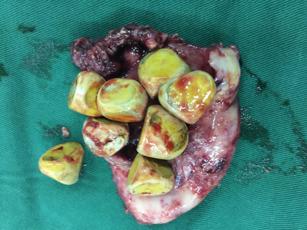 GALL STONE AND GALLBLADDER AFTER LAPAROSCOPIC CHOLECYSTECTOMY
