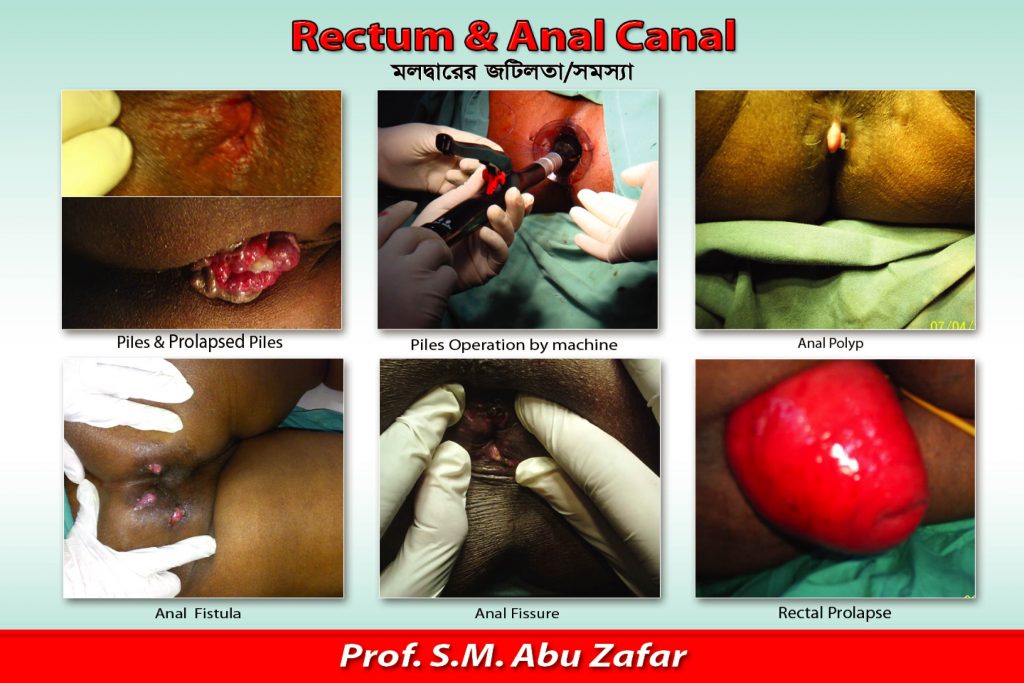 VARIOUS DISEASES OF ANAL CANAL