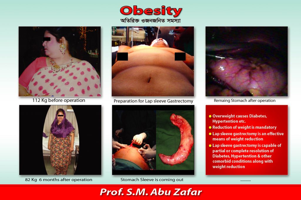 SURGERY FOR OBESITY