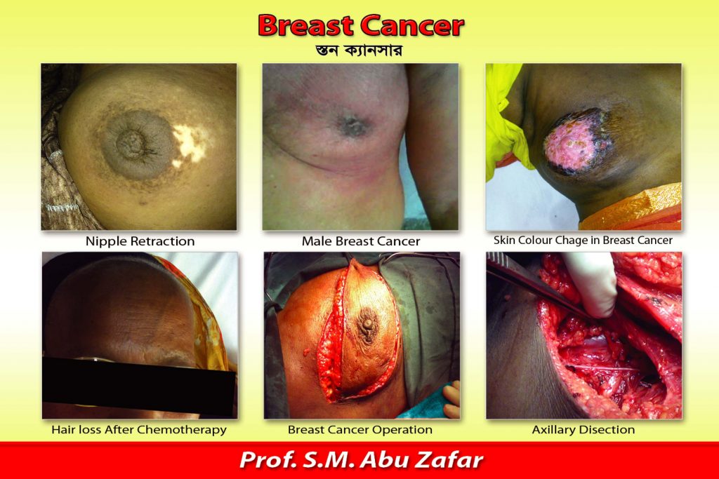 BREAST CANCER