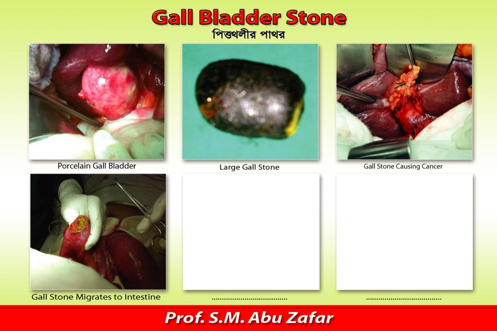 VARIOUS COMPLICATION OF GALLBLADDER STONE