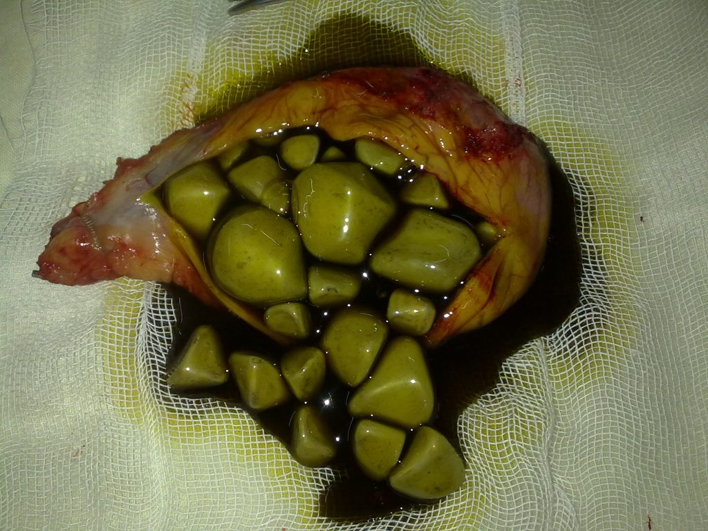 GALL BLADDER WITH STONE AFTER OPERATION BY LAPAROSCOPY