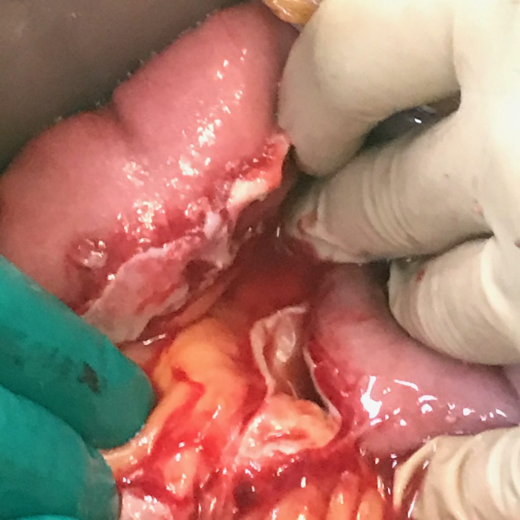 INTER LOOP ABSCESS AFTER PERFORATION OF APPENDIX
