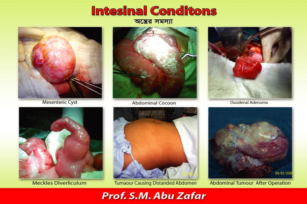 VARIOUS SURGICAL CONDITIONS OF SMALL INTESTINE